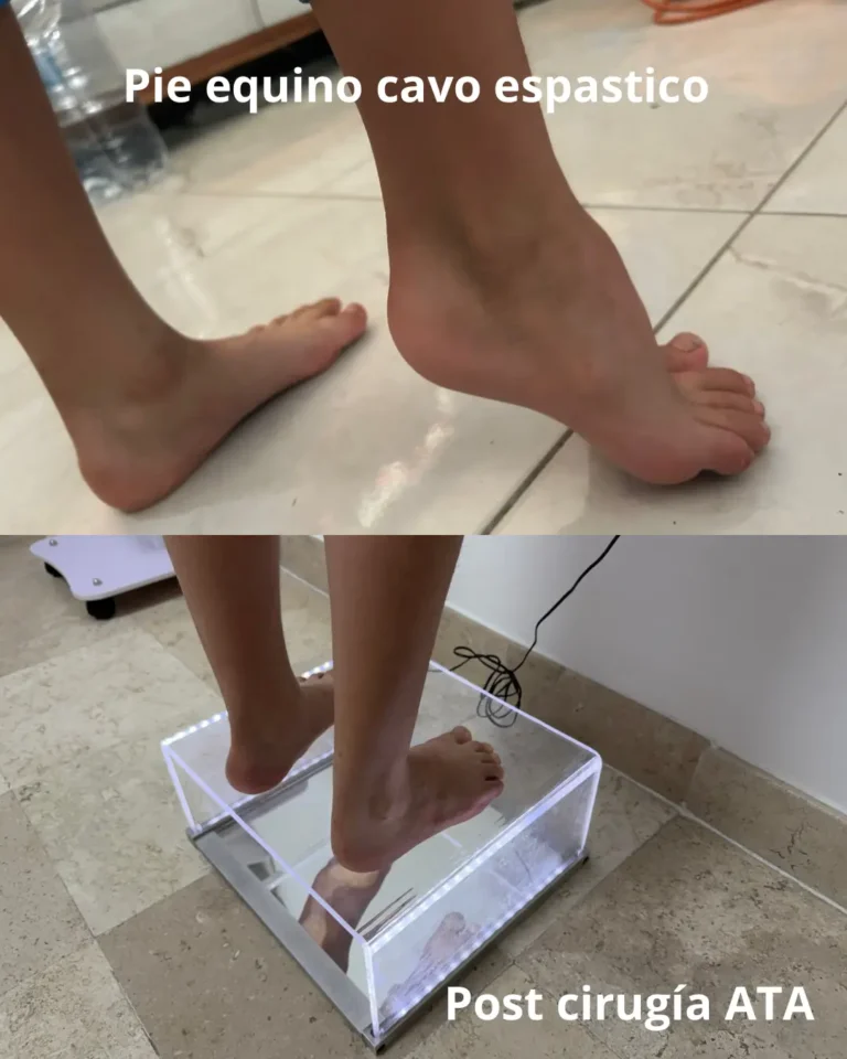 Pie equino cavo espastico